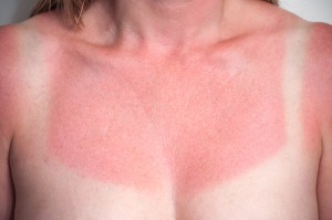 Sun Damage Effects on Chest and Neck