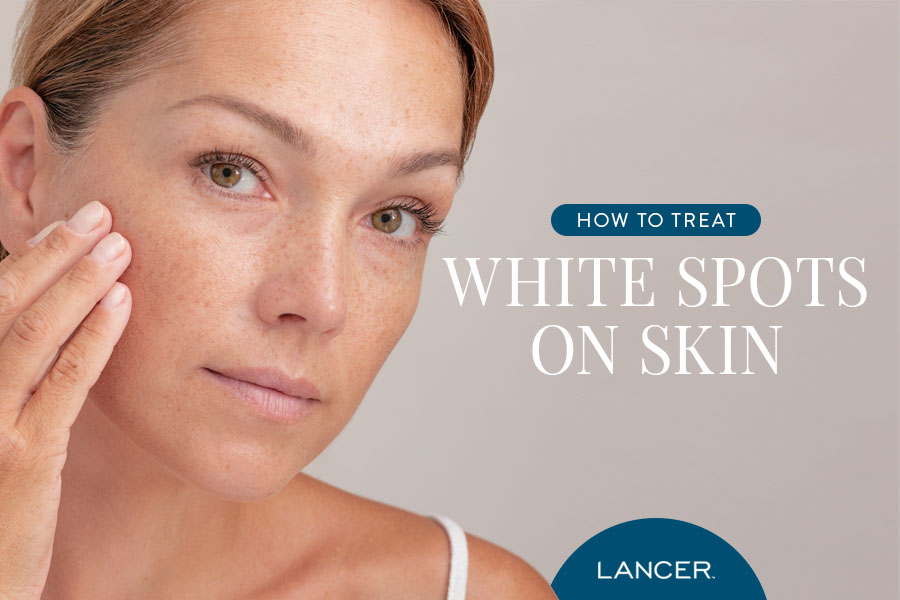 How to Treat White Spots on Skin